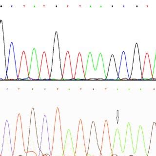 Partial Electropherograms Of The Sry Gene A Normal Sequence B