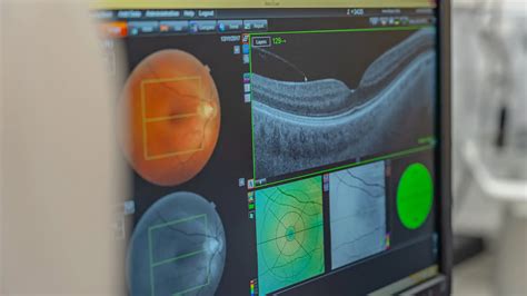 Glaucoma Laser Treatment - My Eye Clinic