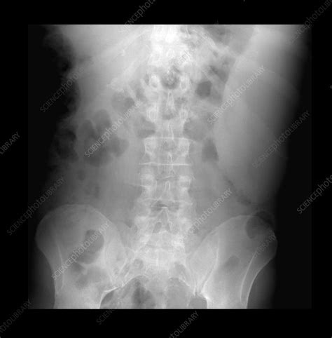 X Ray Of Abdomen Showing Enlarged Spleen Stock Image M