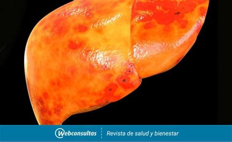 Esteatosis Hepatica Causas Sintomas Tratamiento – Otosection