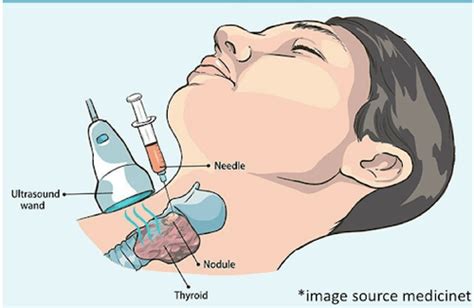 Lymph Nodes Assessment Biopsy