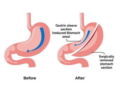 Transform Your Health With Laparoscopic Sleeve Gastrectomy