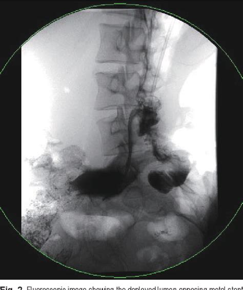 Figure 2 From Reverse Endoscopic Ultrasound Guided Gastrojejunostomy