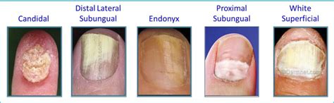 Fungal Nail Infection - Eliminaser