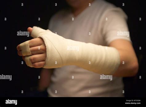 A Broken Arm In A Cast Stock Photo 21583204 Alamy