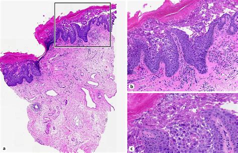 Epidermolytic Acanthoma