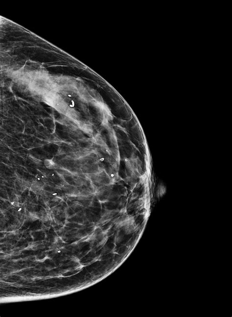 Breast Calcification Bi Rads 2 Image