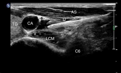 Ultrasound Guided Stellate Ganglion Block