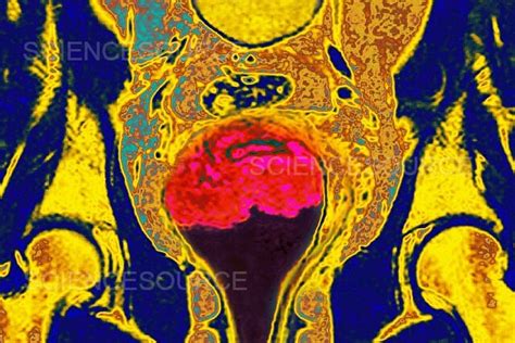 Photograph Cervical Cancer Mri Science Source Images