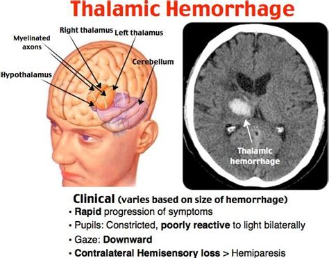 Thalamic Hemorrhage Neurología Escuelas De Medicina Radiología