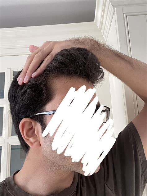 Is this a receding hairline or just maturing? (age: 20) : r/malehairadvice