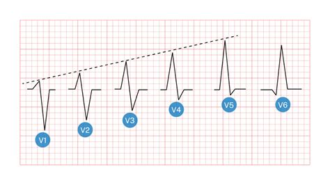 Ecg Qbank Practice Exam Roshreview Hot Sex Picture