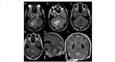 Pre-operative MRI brain demonstrating a heterogeneous, enhancing ...