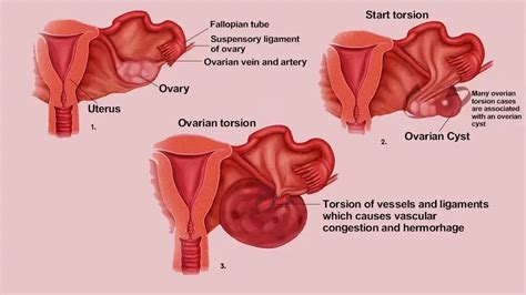 Best Torsion Ovarian Cyst Surgery Specialist in Hyderabad