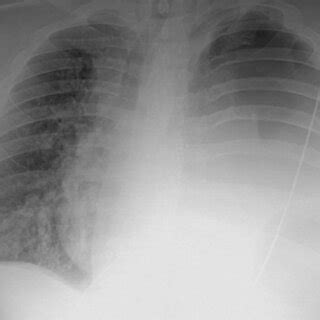 Chest X‐ray showed an overall improvement of the left lung with... | Download Scientific Diagram