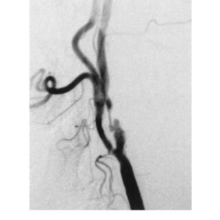 Case Initial Angiogram Of The Left Common Carotid Artery Showing The