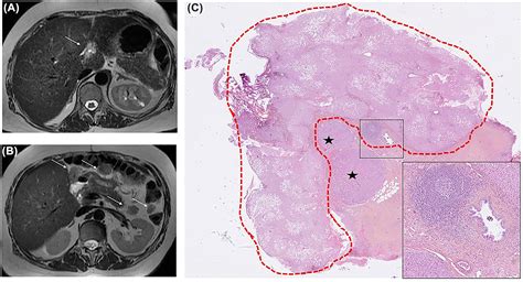 Peritoneal Metastases Of Unknown Primary With Hepatoid Features