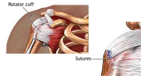 Rotator Cuff Repair - Back in Action