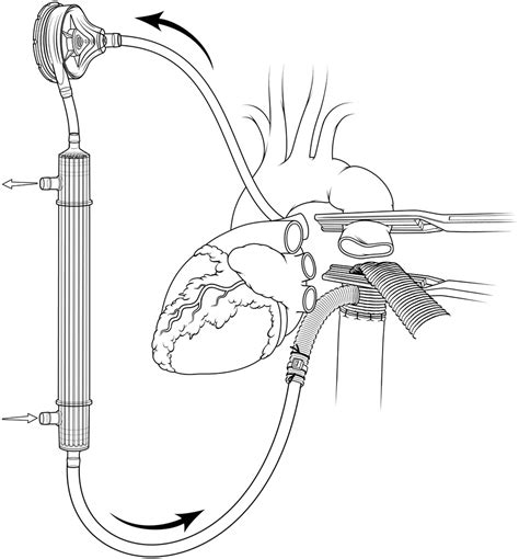 Open Repair Of Adult Aortic Coarctation Mostly By A Resection And Graft Replacement Technique