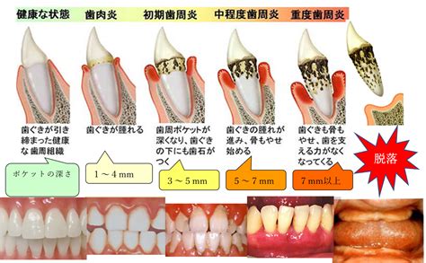 ★成人の8割が罹る歯周病とは？一緒に学んで歯を歯周病から守りましょう！ かつらやま歯科医院千葉市緑区 土気駅近くの歯医者