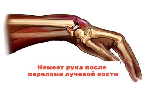 Немеет рука после перелома лучевой кости: причины, что делать