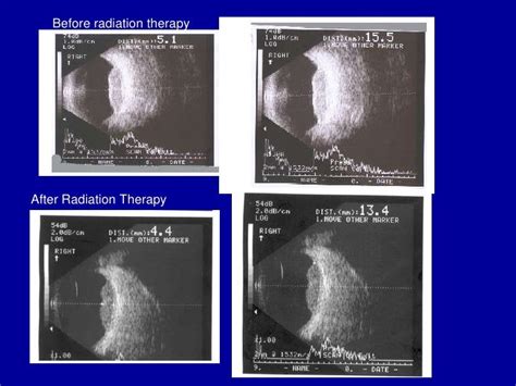 Choroidal Melanoma