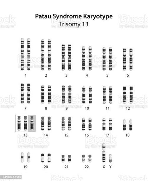 Patau Syndrome Karyotype Stock Illustration Download Image Now Istock