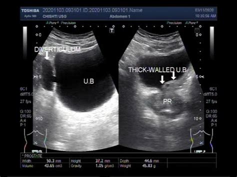 Diverticulum Of Bladder Ultrasound