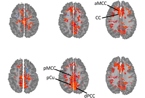 Brain Chemicals Levels Of Chemicals May Reflect Severity Of Autism Traits