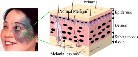 Patient And Skin Structure Of Otas Nevus Download Scientific Diagram