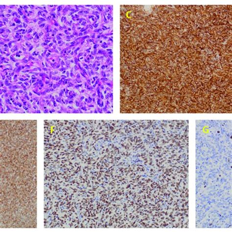 Pathological Characterization Of Solitary Fibrous Tumor Case A