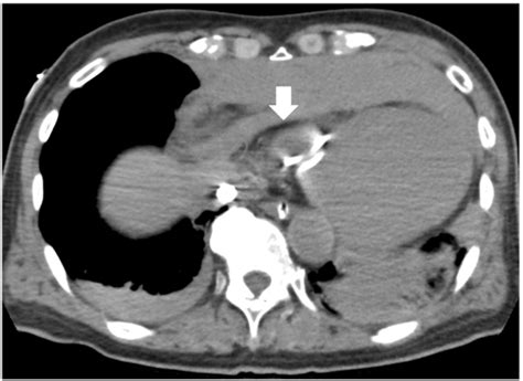 Preoperative Computed Tomography Findings Chest Computed Tomography