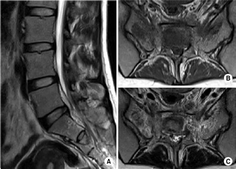 Preoperative Sagittal A And Axial T1 Weighted Magnetic Resonance B Download Scientific