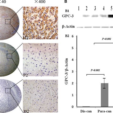 Comparative Analysis Of Gpc 3 Expression In Hcc Tissues At Different