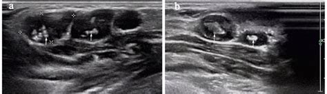 Cervical Ultrasonography Of The Lymph Nodes Lns Shows Strong Echo A