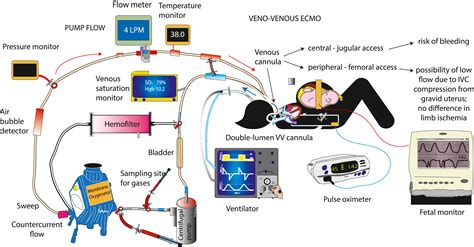 Extracorporeal Membrane Oxygenation In Pregnancy During The Sars Cov 2