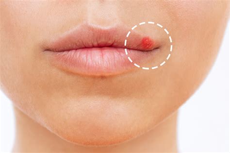 Primer Plano Del Herpes En El Labio Ampollas En La Boca De Una Mujer