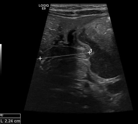 Pyloric Stenosis Image