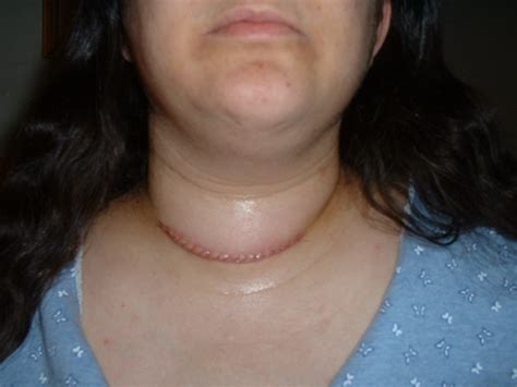 Poppetree : Scar from thyroidectomy.