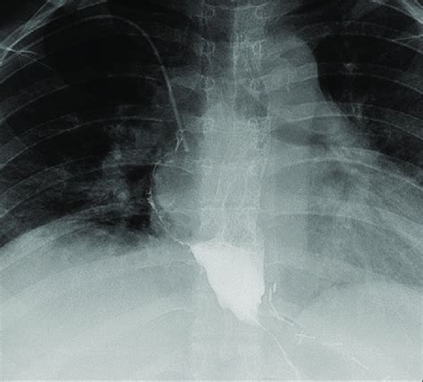 A Water Soluble Contrast Swallow Study Clearly Showed The Fistula Tract