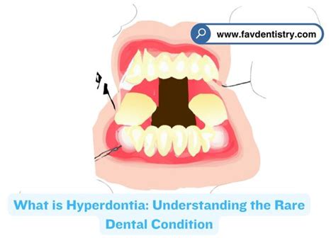 What Is Hyperdontia Understanding The Rare Dental Condition