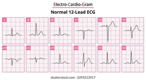 Normal Ecg Reading