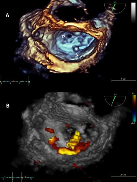Ecocardiograf A Tridimensional En Tiempo Real En Casos De