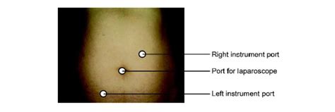 Laparoscopic Tubal Surgery