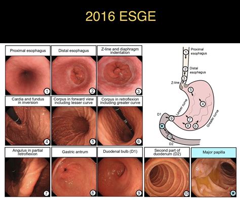 Upper Endoscopy And Prep — Gastroenterology East Pa