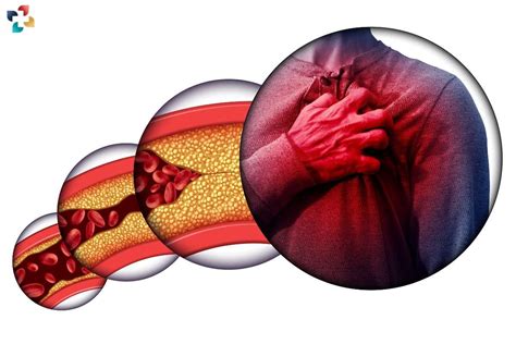 7 Common Atherosclerosis Symptoms | The Lifesciences Magazine