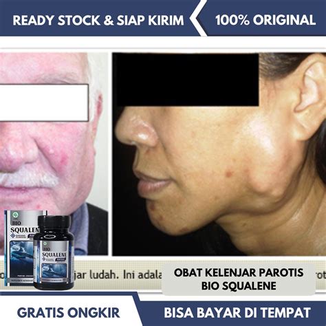 Jual Obat Kelenjar Parotis Tumor Jinak Parotis Kelenjar Air Liur