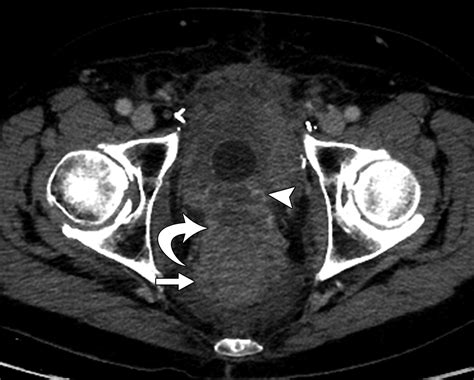 Imaging Features Of Carcinoid Tumors Of The Gastrointestinal Tract Ajr