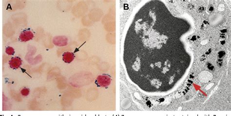 [pdf] Sideroblastic Anemia Diagnosis And Management Semantic Scholar