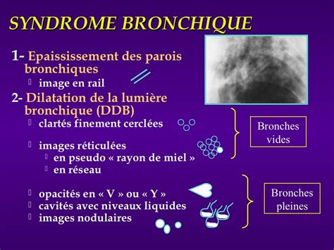 Syndrome Bronchique